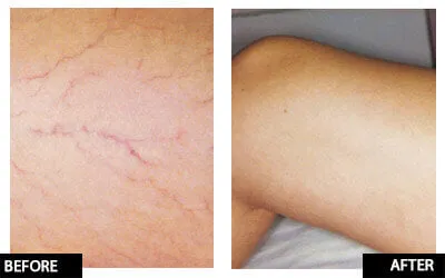 Laser thread vein removal for full legs 2 1 FREE! (save €201)